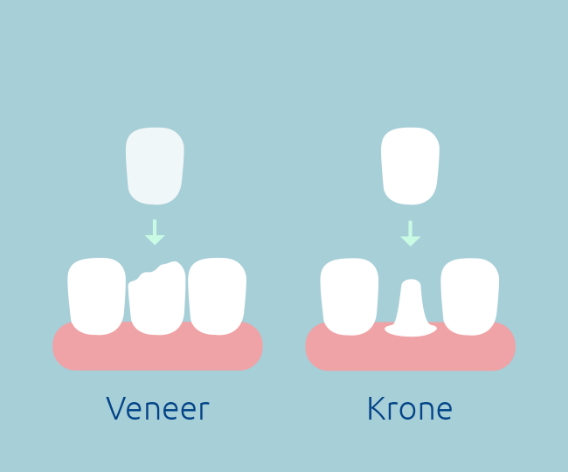 Veneer und Krone